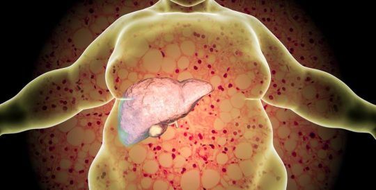 Hígado graso: Síntomas, tipos, causas y tratamiento