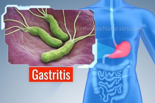 10 Remedios caseros para la gastritis, el #2 es el más efectivo