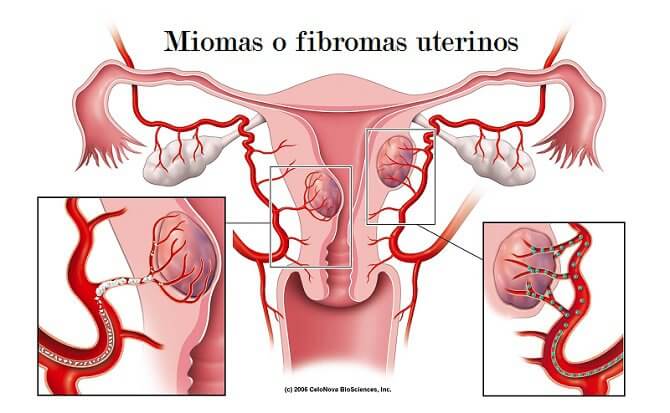 Miomas uterinos: 5 cosas que deberíamos saber